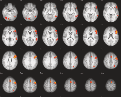 Language fMRI activation map showing left-lateralised language regions