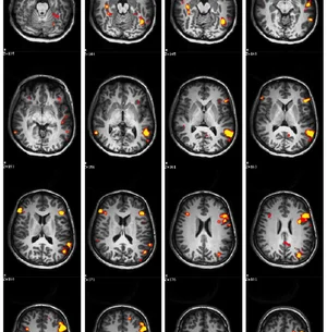 Language fMRI brain map