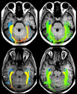 Optic radiation tractography